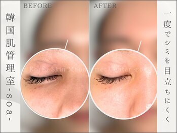 韓国肌管理室 ソア(soa)/【1度でシミを目立ちにくく】