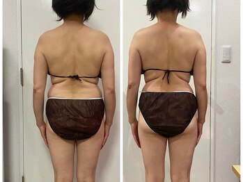 ランス/1回の施術での変化