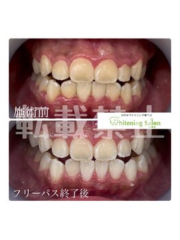 ホワイトニングサロン 札幌店/【ホワイトニング】#札幌#大通り