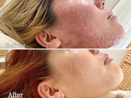 ニキビケア研究所 吉祥寺店の写真