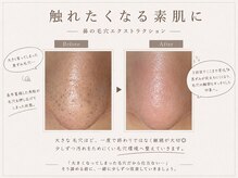 イエルカ(YELCA)の雰囲気(頑固なイチゴ鼻もここまで変わる!毛穴レスな素肌に♪)