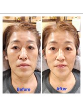 アン 銀座(ann)/レモンボトル&エクソソーム