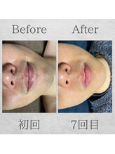 サンライズ(Sunrise)/Before After ☆