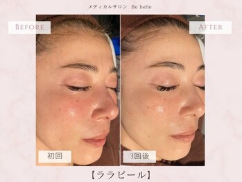 ビベル 八木店(Bebelle)/40・50代の肌悩みにはララピール