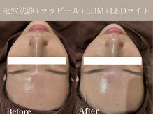 リィ プラス(Riii plus)/毛穴洗浄+ララピール+LDM+ LED