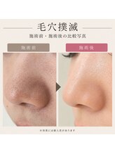 ボーテヌール(Beaute Nheur)/エステ版ダーマ＋毛穴洗浄