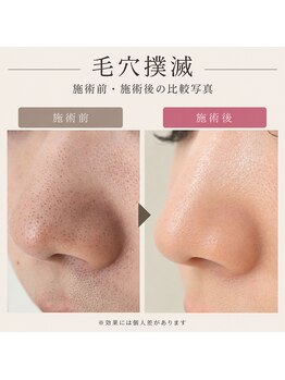 ボーテヌール(Beaute Nheur)/エステ版ダーマ＋毛穴洗浄