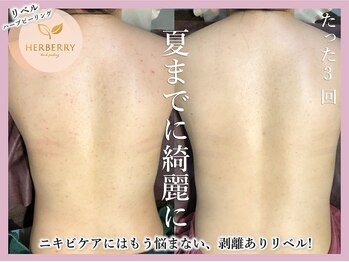 ハーバリー ハーブピーリング 難波心斎橋店(HERBERRYハーブピーリング)/なんばハーブピーリングHERBERRY