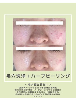 ソワナ(soina)/【神楽坂駅/フェイシャル/毛穴】