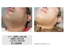 ザ エッセンシャル 碧南(THE Essential)/メンズ　ヒゲ脱毛