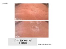 トータルクリア(TOTAL CLEAR)/Gloss肌ピーリング