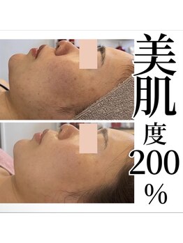 癒える(ielu)/次世代ハーブピーリング★顔