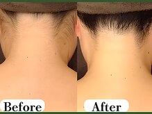 ビースキン 広島(BE:SKIN)/全身脱毛/フェイシャル/VIO