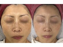 ハナ(HANA)の雰囲気(プラズマシャワーでシミ、シワ、くすみが緩和されました◎)