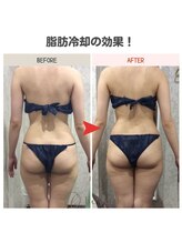 ビーフィール 池袋店(be feel)/背中・ヒップ・太もももスッキリ