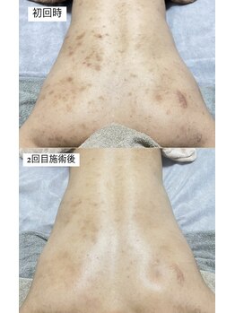 クレヴィー(Creviy)/背中ハーブピーリング