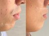 【青ヒゲをなくしたい男性 人気No1】ヒゲ脱毛トライアル（顔全体6ヵ所）