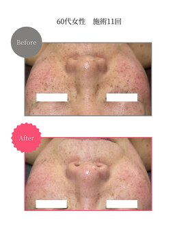 ボータン 恵(Beau Temps)/ウルトラ光トーニング/シミ改善