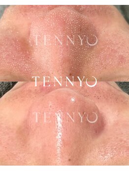 ミハン ボーテ(mihan.beaute)/肌育毛穴洗浄