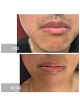 ダンニヒル(dannihil)/【脱毛】４０代会社員１８回目