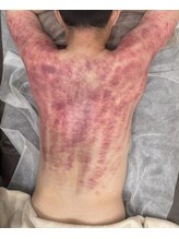 ブランシュムーニー(BRANCHE MOONY)/首元（二の腕）アザなしも♪