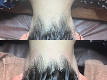 ゴールデンエイジ 吉祥寺(GOLDEN AGE)/ワックス脱毛 : 施術