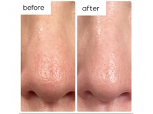 レガロビューティ 麻布十番(REGALO Beauty)の雰囲気（毛穴開きも黒ずみも一スキンケアのみの２ヶ月の変化）