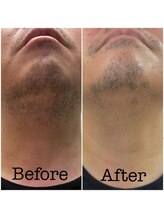 ファビー(Fabby)/メンズ脱毛★髭のビフォアフ