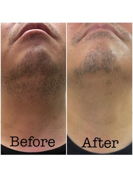 ファビー(Fabby)/メンズ脱毛★髭のビフォアフ