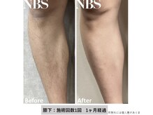 リネ(Rine)/before→after