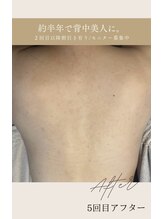 ビューティリュクス(beauty luxe)/背中美人luxe流ハーブピーリング