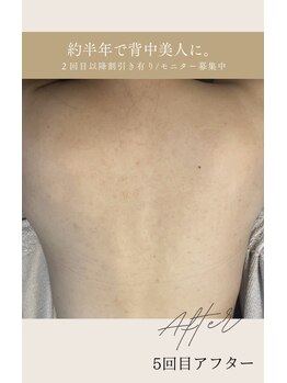 ビューティリュクス(beauty luxe)/背中美人luxe流ハーブピーリング