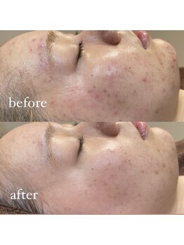 レシェルサロン(Lechelle Salon)/美白/陶器肌/水光肌/韓国肌