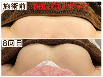 ビジュラン グロスキングツヤ王(Bijuran GlossKingツヤ王)/BBLバストアップ８回の変化