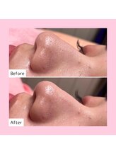 ホワイトラボ 新潟万代(White labo)/【施術例】ハイドロフェイシャル