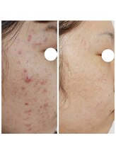 アンティクイーン(Antiqueen)/大人気★VOSサロンケア