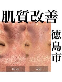 サロンツキ(salon tuki)/肌質改善/徳島市