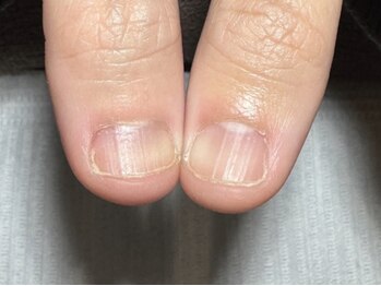 プラスワン(+1)/即見た目改善(2)ビフォー