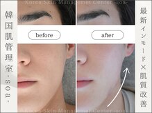 韓国肌管理室 ソア(soa)/【最新インモード×肌質改善】
