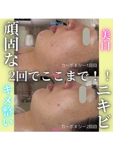 ハニエル(Haniel)/カーボキシービフォーアフター