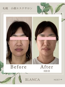 ブランカ(BLANCA)/小顔セラピアビフォーアフター
