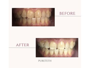 ピュアティス(PURETETH)/40代男性　before &after