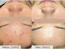 オーキッド(ORCHID)/ニキビケア♪