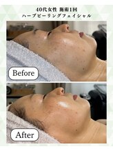 シーフェイス 横浜店(SEE FACE)/40代ハーブピーリングモニター