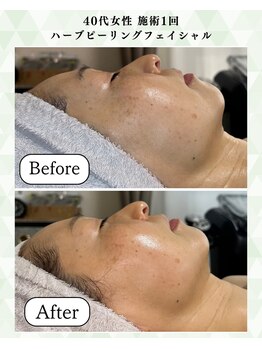 シーフェイス 横浜店(SEE FACE)/40代ハーブピーリングモニター