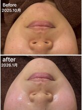 ヴィヴィアン 豊橋店(Vivian)/肌も生き返る◎ハーブピーリング