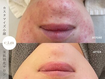 エイム(e.i.m)/30代：肌荒れ/赤み