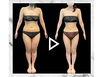 エステティック エイチアンドビー 大和店(H&B)/ビフォーアフター