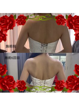 ディア スプリーマ/ブライダルエステ★6回目