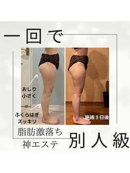 アクアリジェ/施術後3日かけてさらに落ちます